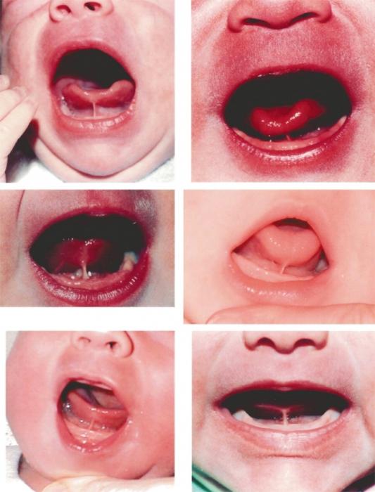 Frenomul scurt al limbii la copil