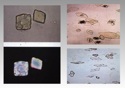 Cristale amorfe în urină: caracteristici, decodificări și indici