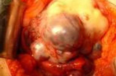 Cum se tratează cancerul ovarian în Israel?