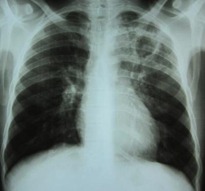 Focul Gon asupra tuberculozei pulmonare